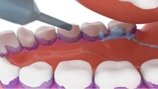 Ventilator Associated Pneumonia (VAP): Development and prevention